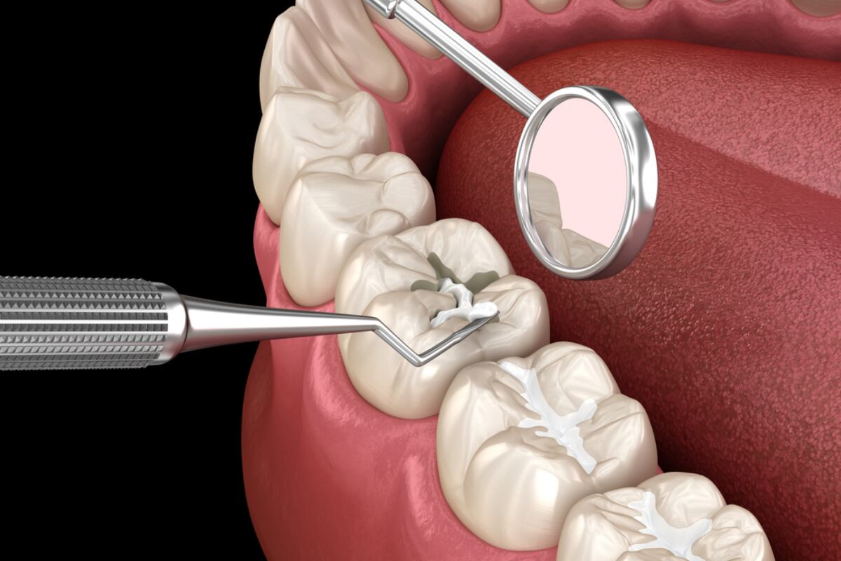 7 signs you may need a composite fillings